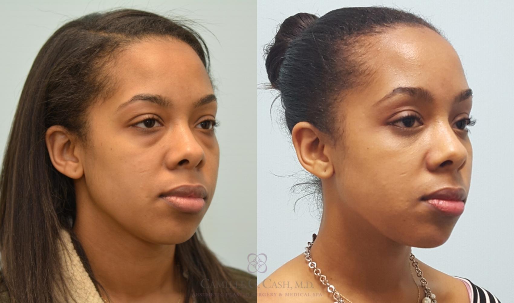 Before & After Eyelid Surgery Case 143 View #4 View in Houston, TX