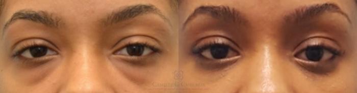 Before & After Eyelid Surgery Case 143 View #5 View in Houston, TX