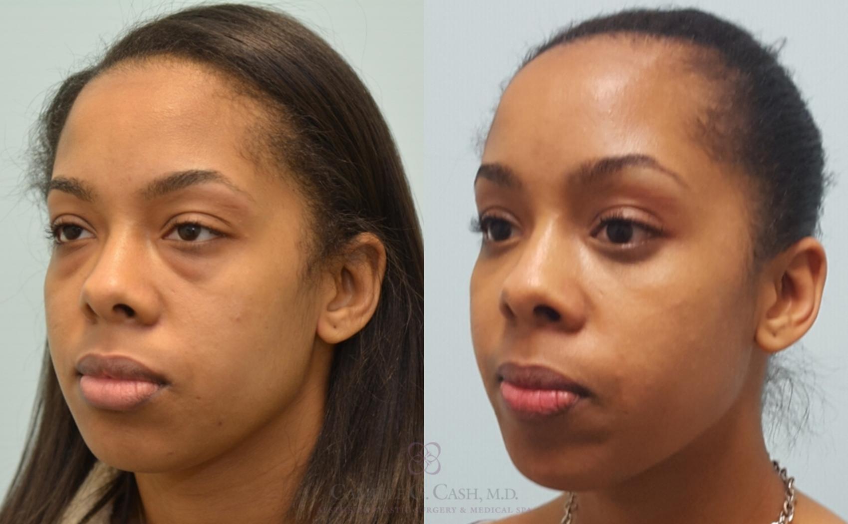 Before & After Eyelid Surgery Case 143 View #6 View in Houston, TX