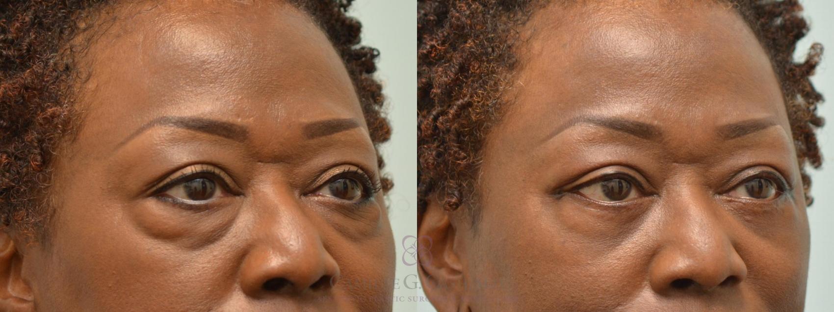 Before & After Eyelid Surgery Case 146 Left Oblique View in Houston, TX
