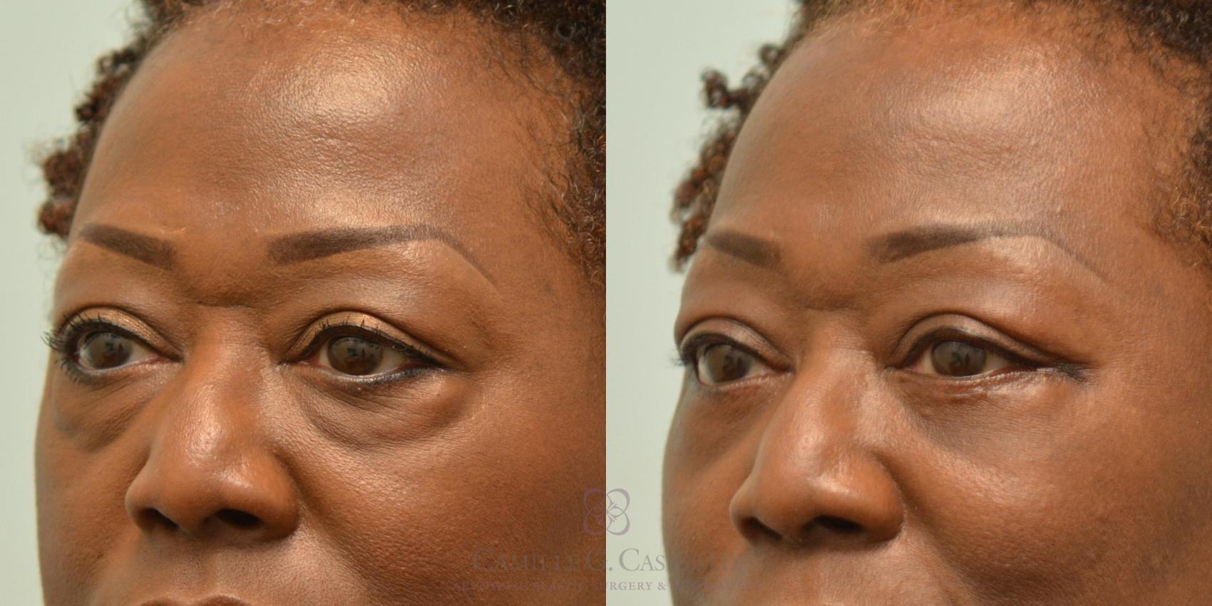 Before & After Eyelid Surgery Case 146 Right Oblique View in Houston, TX