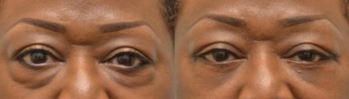 Before & After Eyelid Surgery Case 146 View #1 View in Houston, TX