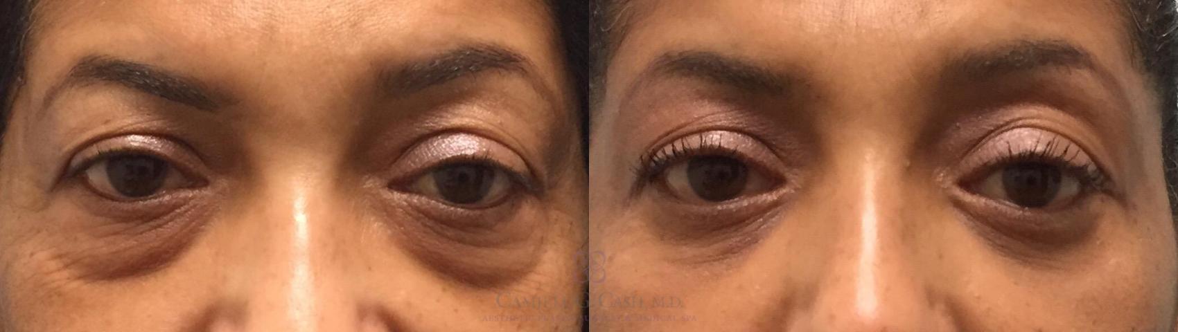 Before & After Eyelid Surgery Case 200 View #2 View in Houston, TX