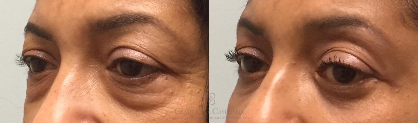 Before & After Eyelid Surgery Case 200 View #3 View in Houston, TX