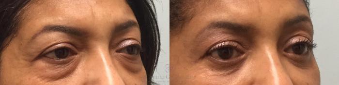 Before & After Eyelid Surgery Case 200 View #4 View in Houston, TX