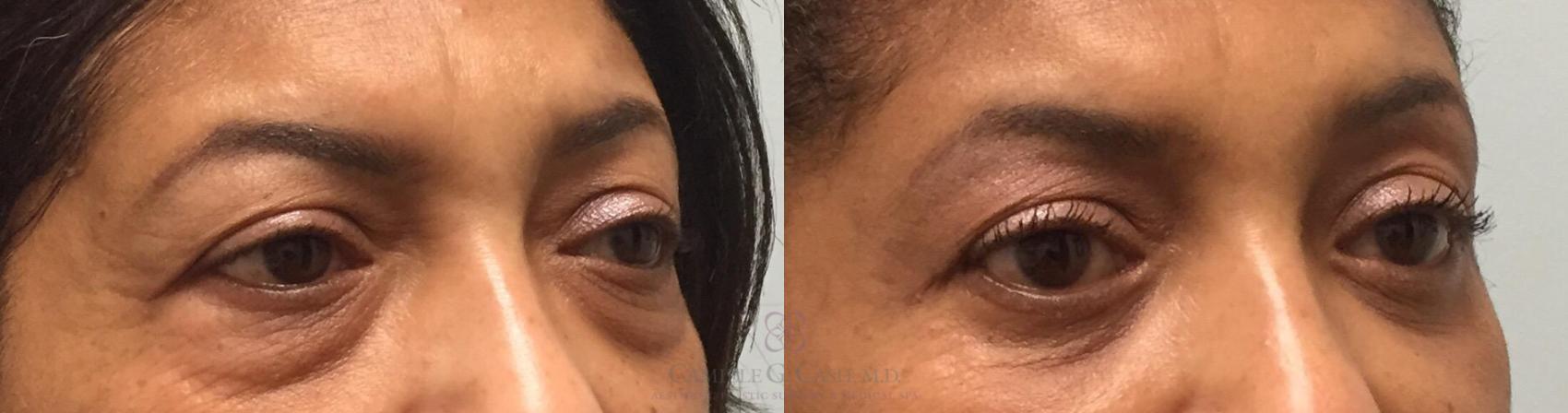 Before & After Eyelid Surgery Case 200 View #5 View in Houston, TX