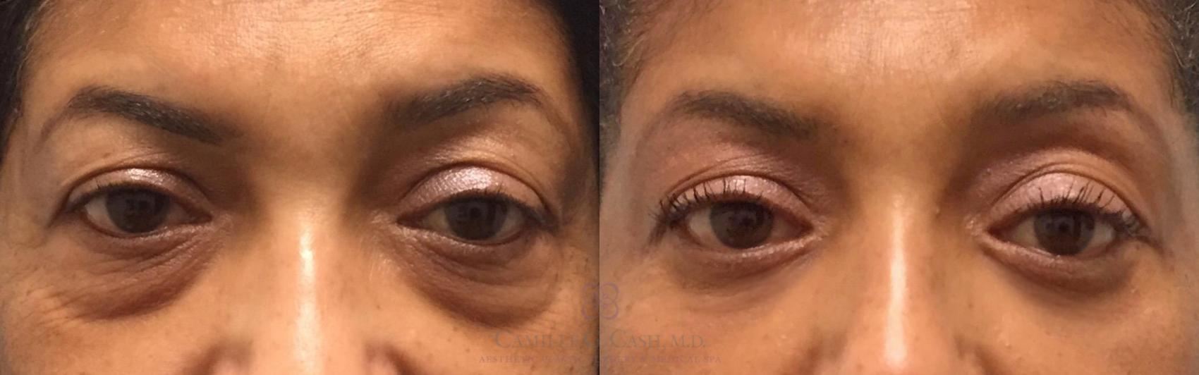 Before & After Eyelid Surgery Case 200 View #6 View in Houston, TX
