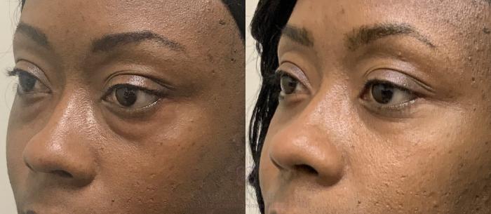 Before & After Eyelid Surgery Case 377 View #1 View in Houston, TX