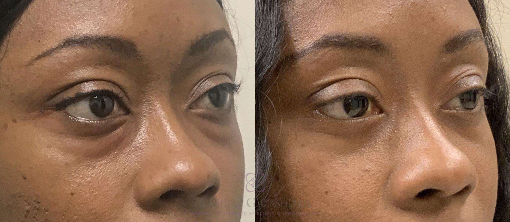 Before & After Eyelid Surgery Case 377 View #2 View in Houston, TX