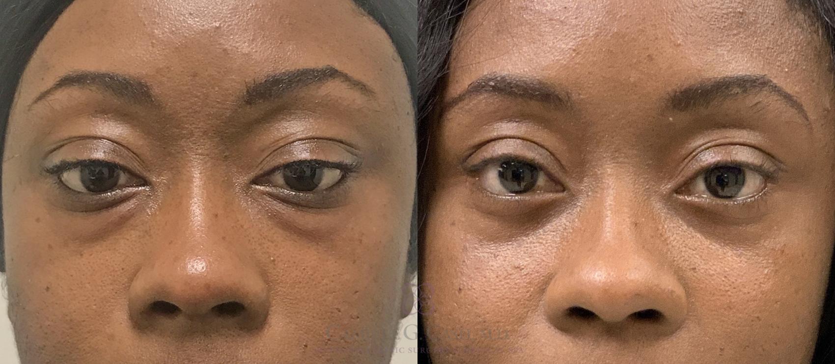 Before & After Eyelid Surgery Case 377 View #3 View in Houston, TX