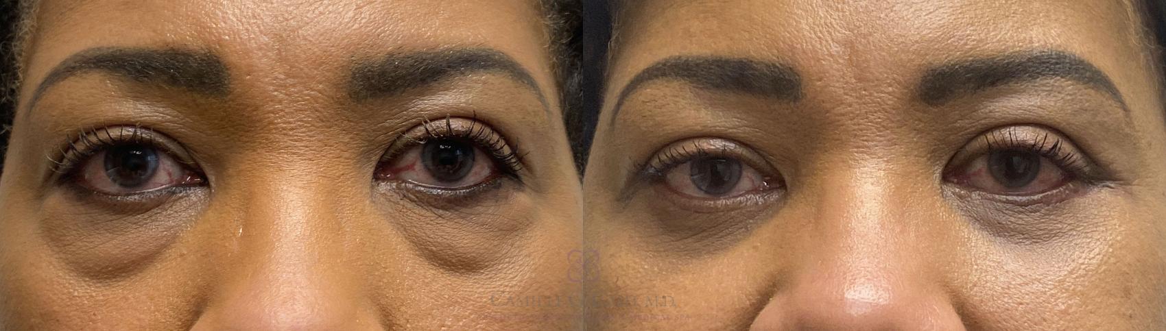 Before & After Eyelid Surgery Case 394 View #1 View in Houston, TX