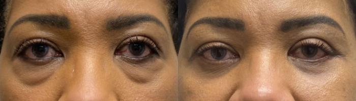 Before & After Eyelid Surgery Case 394 View #1 View in Houston, TX