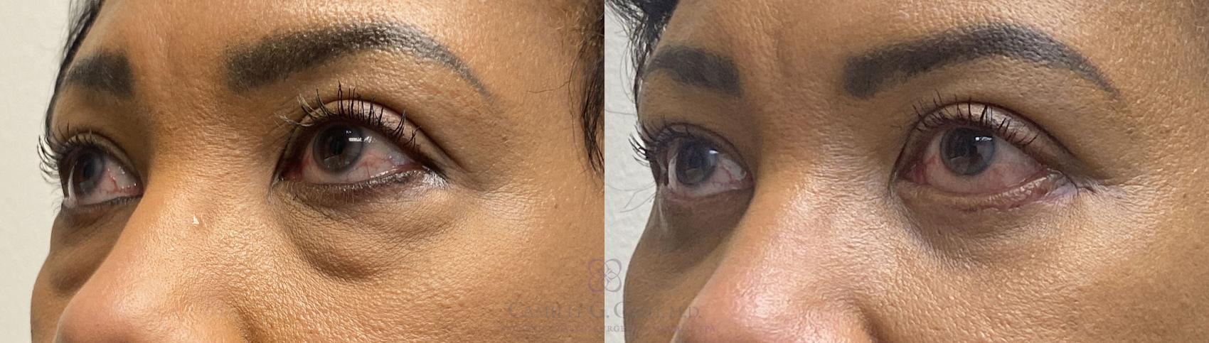 Before & After Eyelid Surgery Case 394 View #2 View in Houston, TX