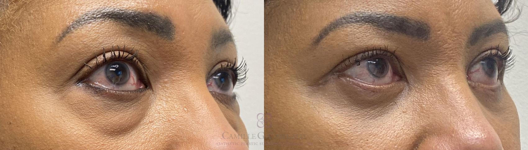 Before & After Eyelid Surgery Case 394 View #3 View in Houston, TX