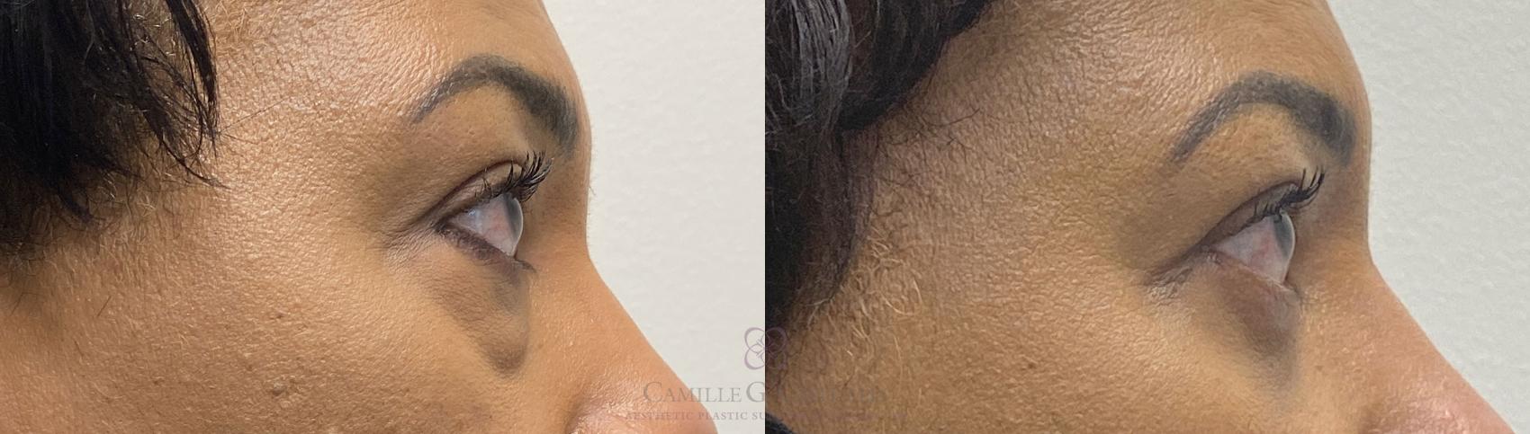 Before & After Eyelid Surgery Case 394 View #4 View in Houston, TX