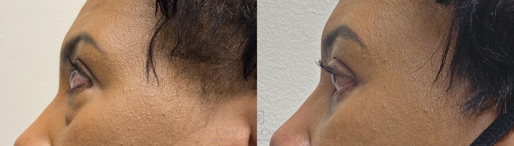 Before & After Eyelid Surgery Case 394 View #5 View in Houston, TX