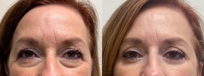 Before & After Eyelid Surgery Case 489 front 2 View in Houston, TX