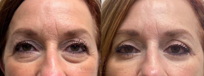 Before & After Eyelid Surgery Case 489 Front View in Houston, TX