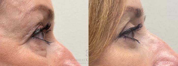 Before & After Eyelid Surgery Case 489 Left Side View in Houston, TX