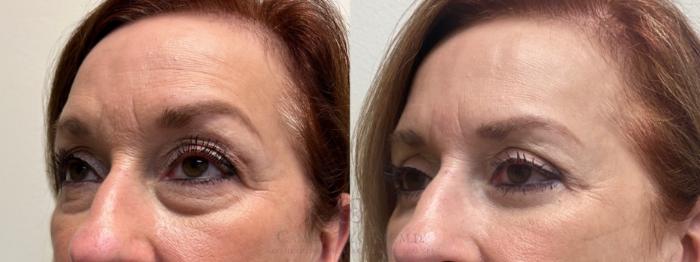 Before & After Eyelid Surgery Case 489 Right Oblique View in Houston, TX