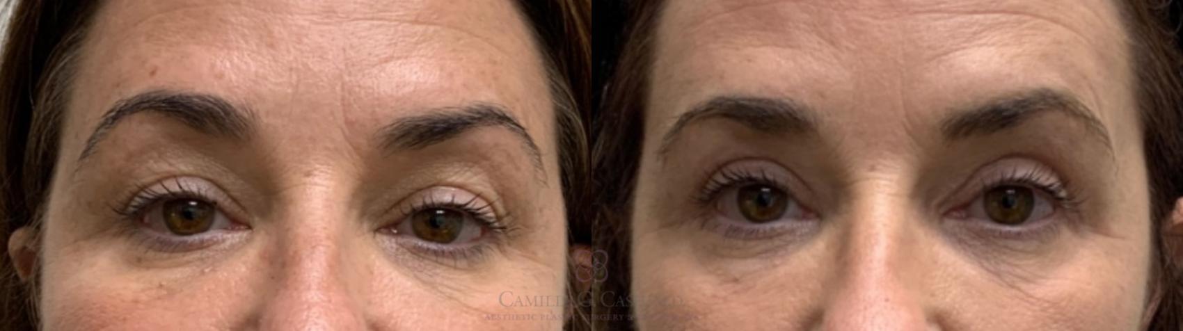 Before & After Eyelid Surgery Case 490 Front View in Houston, TX