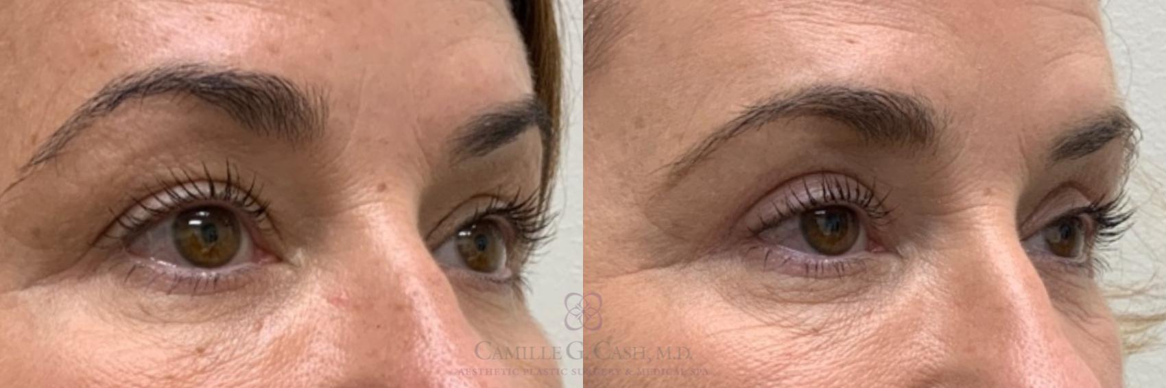 Before & After Eyelid Surgery Case 490 Left Oblique View in Houston, TX