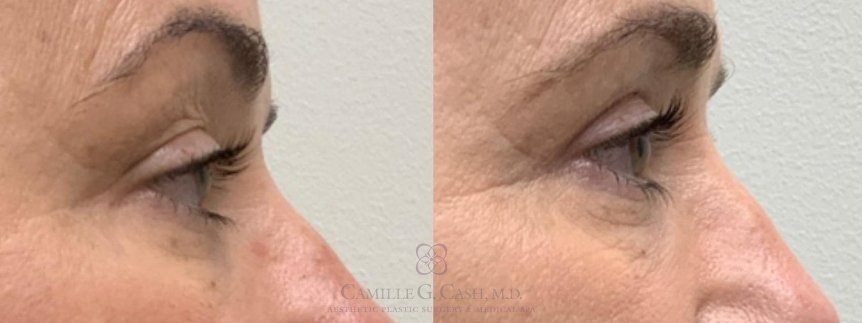 Before & After Eyelid Surgery Case 490 Left Side View in Houston, TX