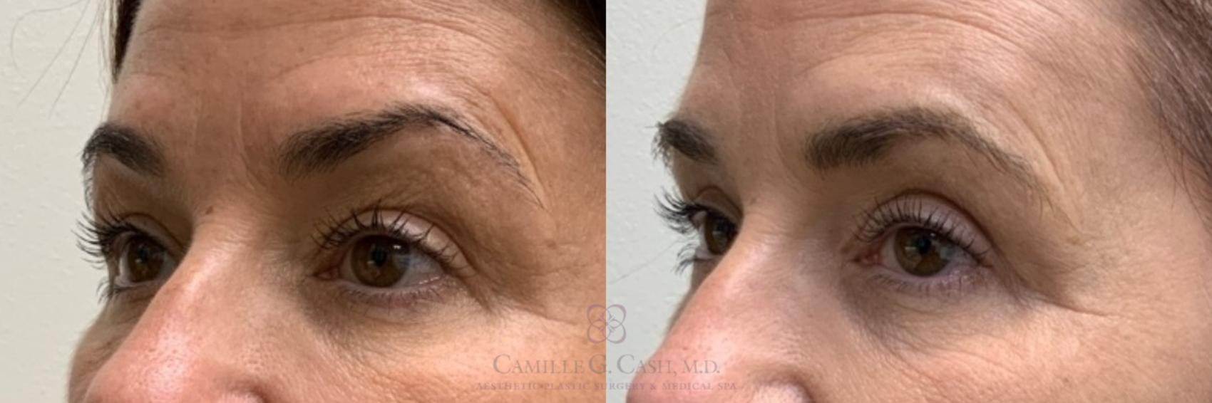 Before & After Eyelid Surgery Case 490 Right Oblique View in Houston, TX
