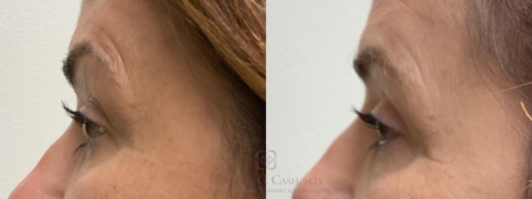 Before & After Eyelid Surgery Case 490 Right Side View in Houston, TX