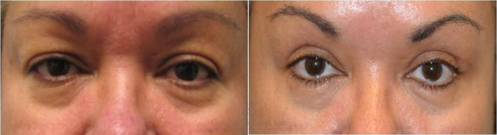 Before & After Eyelid Surgery Case 55 View #1 View in Houston, TX