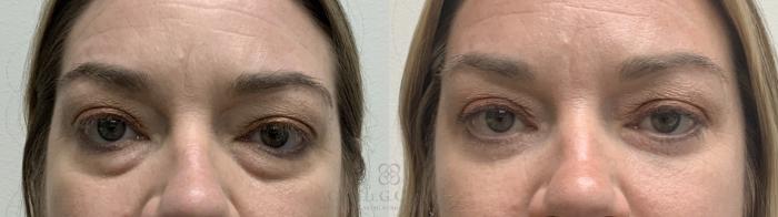 Before & After Eyelid Surgery Case 552 11 month follow up front View in Houston, TX