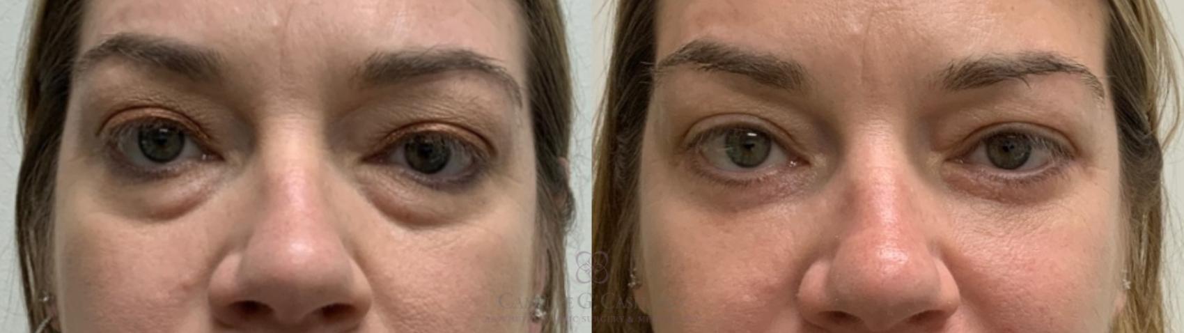 Before & After Eyelid Surgery Case 552 Front View in Houston, TX