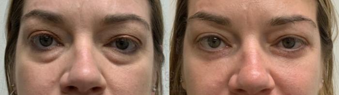 Before & After Eyelid Surgery Case 552 Front View in Houston, TX