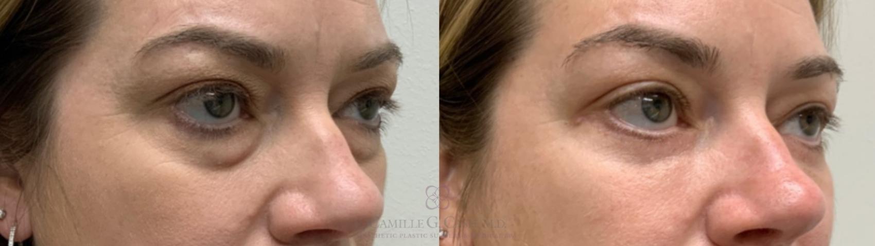 Before & After Eyelid Surgery Case 552 Left Oblique View in Houston, TX