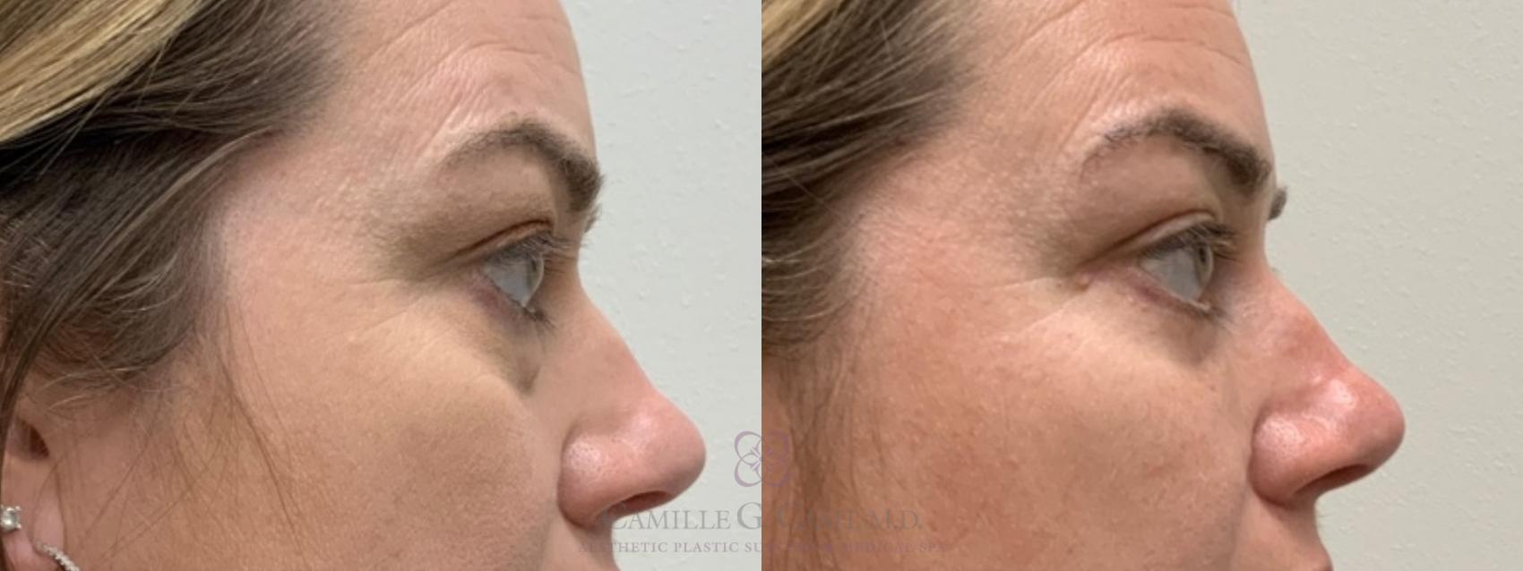 Before & After Eyelid Surgery Case 552 Left Side View in Houston, TX