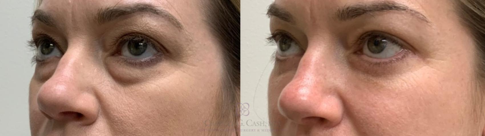 Before & After Eyelid Surgery Case 552 Right Oblique View in Houston, TX