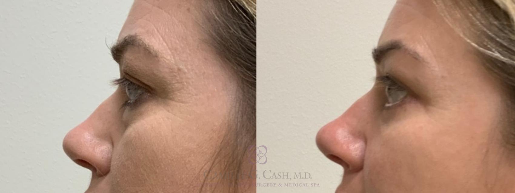 Before & After Eyelid Surgery Case 552 Right Side View in Houston, TX