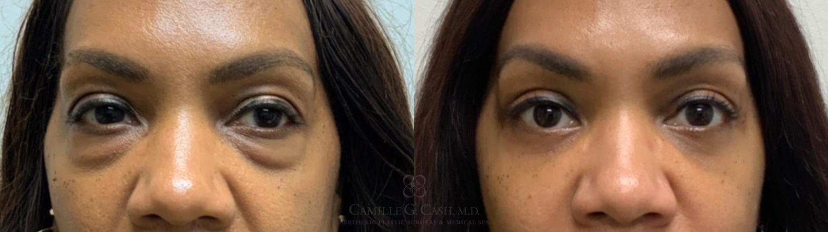 Before & After Eyelid Surgery Case 589 Front View in Houston, TX