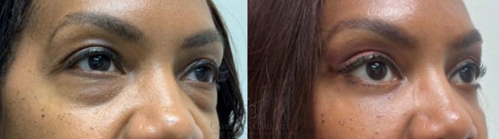 Before & After Eyelid Surgery Case 589 Left Oblique View in Houston, TX