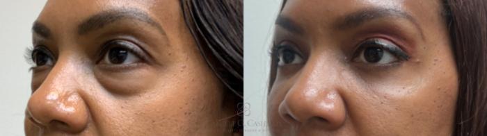 Before & After Eyelid Surgery Case 589 Right Oblique View in Houston, TX