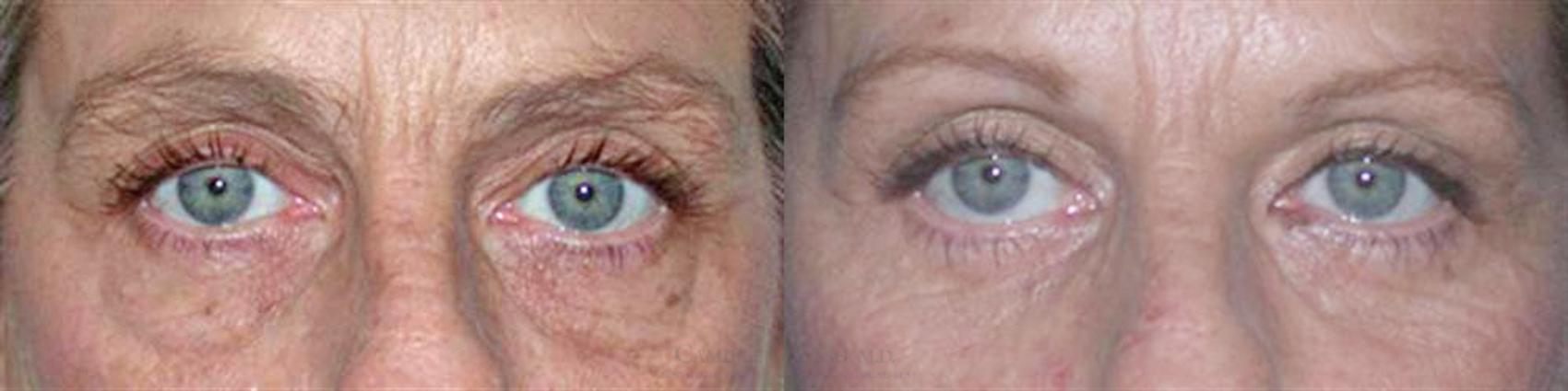 Before & After Eyelid Surgery Case 6 View #1 View in Houston, TX