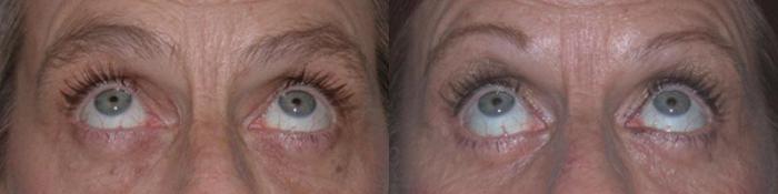 Before & After Eyelid Surgery Case 6 View #2 View in Houston, TX