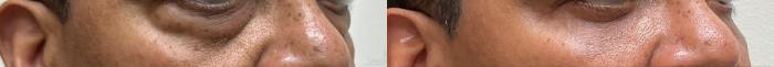 Before & After Eyelid Surgery Case 706 Right Oblique View in Houston, TX