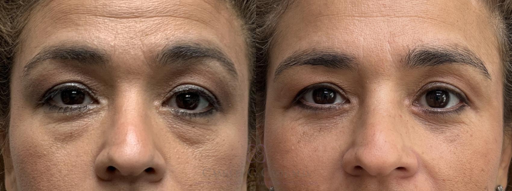 Before & After Eyelid Surgery Case 713 front 4 month View in Houston, TX