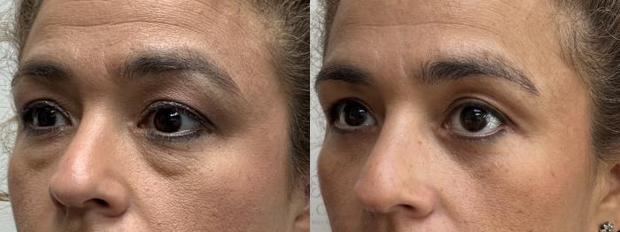 Before & After Eyelid Surgery Case 713 Left Oblique View in Houston, TX