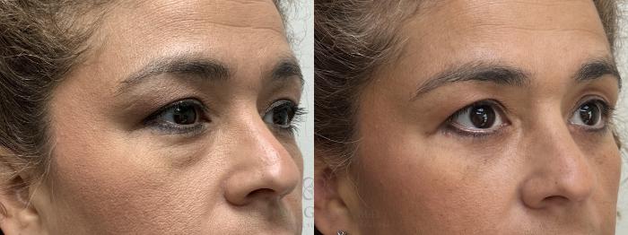 Before & After Eyelid Surgery Case 713 Right Oblique View in Houston, TX