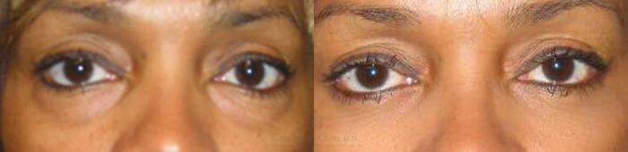 Before & After Eyelid Surgery Case 82 View #1 View in Houston, TX