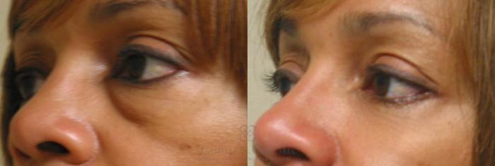 Before & After Eyelid Surgery Case 82 View #3 View in Houston, TX