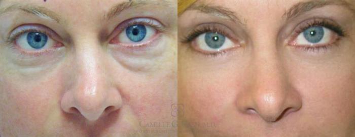 Before & After Eyelid Surgery Case 94 View #1 View in Houston, TX