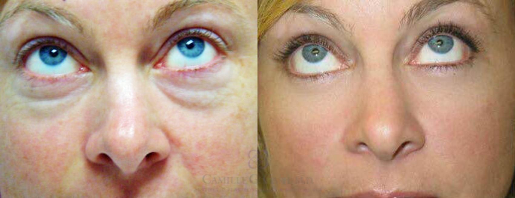 Before & After Eyelid Surgery Case 94 View #2 View in Houston, TX